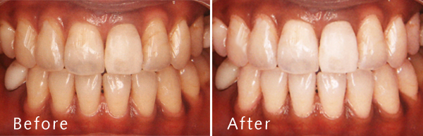 ホワイトニングイメージ