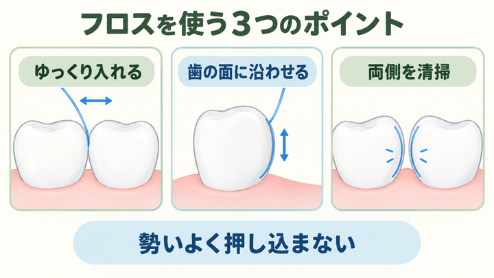 フロスをゆっくり入れ、歯の面に沿わせて上下に動かし、隣り合う両側の歯の面を清掃する模式図。勢いよく押し込まないことも示している。
