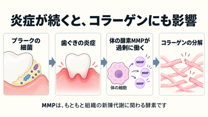 プラークの細菌、歯ぐきの炎症、体の酵素MMPの過剰な働き、コラーゲンの分解を左から順に示す模式図。MMPは体の細胞から出る酵素として描かれている。
