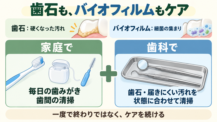 歯石は硬くなった汚れ、バイオフィルムは細菌の集まり。家庭では毎日の歯みがきと歯間清掃、歯科では歯石や届きにくい汚れを状態に合わせて清掃し、継続することを示す図。