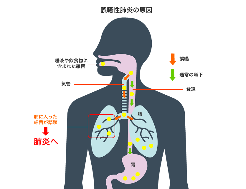 誤嚥性肺炎の原因