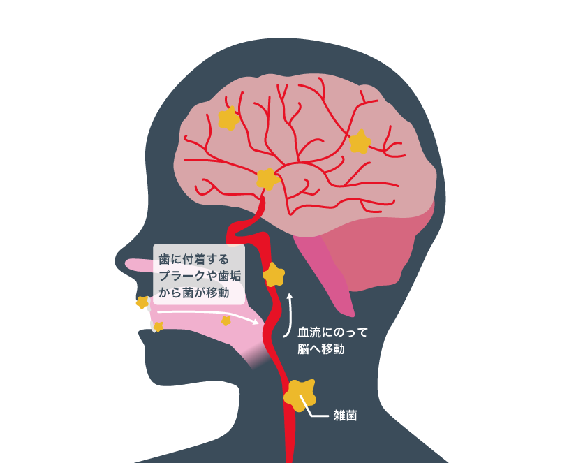 口腔から脳へ菌が移動