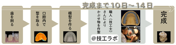 従来のかぶせ物の作製工程