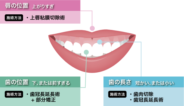 ガミースマイル治療について