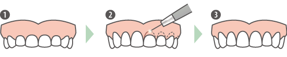歯冠長延長術イメージ