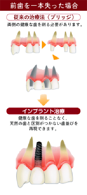 前歯を一本失った場合