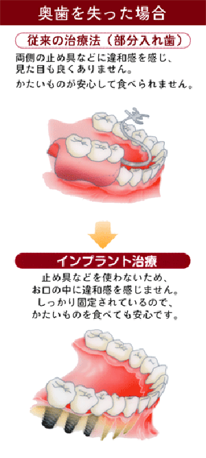奥歯を失った場合