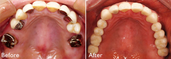 インプラント治療例３