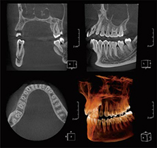 歯科用CT