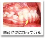小児矯正 前歯が逆さになっている