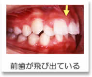 小児矯正 前歯が飛び出している