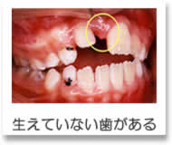 小児矯正 生えてない歯がある