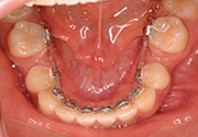 舌側矯正イメージ3