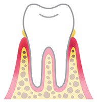 歯肉炎