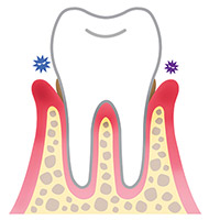 歯周病