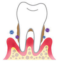 歯周病