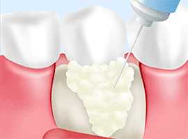 歯周外科