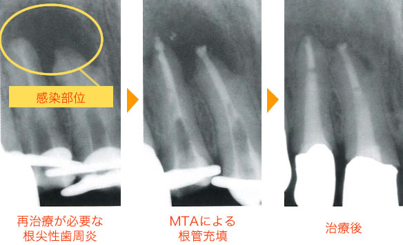 MTA治療イメージ01