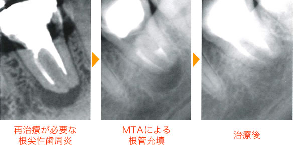 MTA治療イメージ02