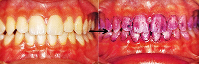プラークの染め出し