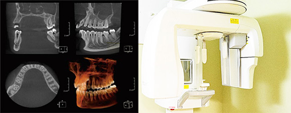 歯科用ＣＴ