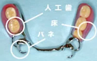 金属のバネが付いた部分入れ歯。人工歯・床・バネの位置を文字と丸で示している
