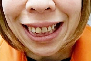 笑ったときの口元の治療後の写真
