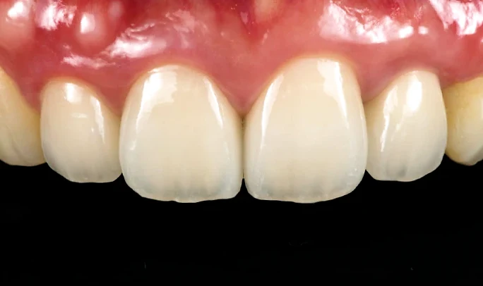 症例5の治療後の前歯の写真
