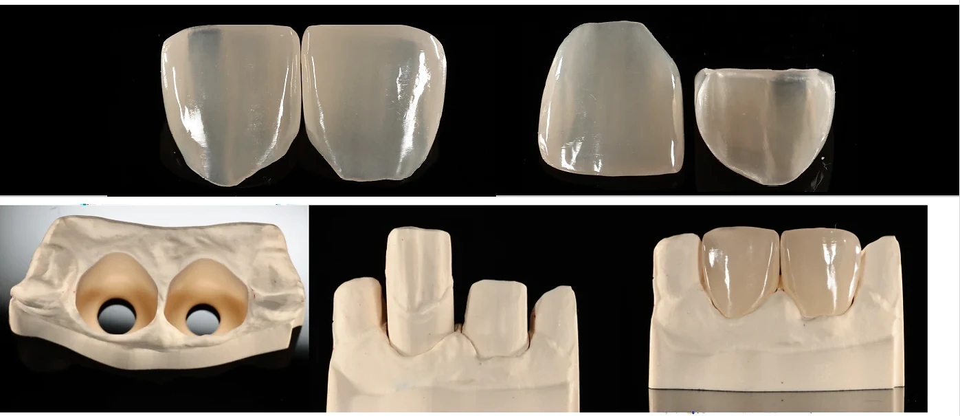 製作したラミネートベニアとかぶせ物、作業用の模型の写真