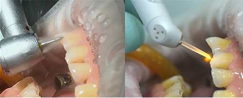 左はドリルで水しぶきを上げて削る様子、右はレーザーの先から光を当てる様子
