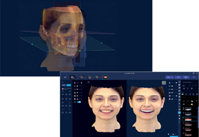 CTを重ねた3Dの顔と、治療前後を並べたシミュレーション画面