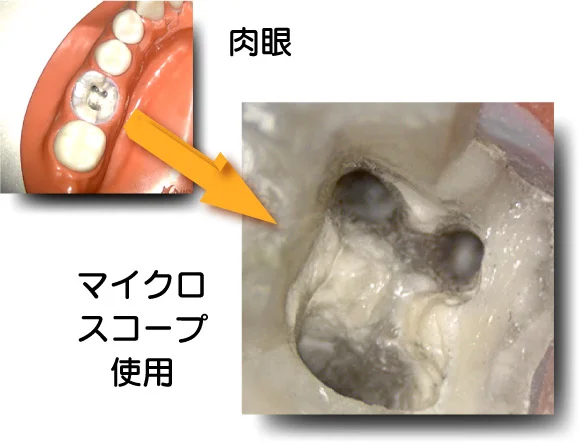 同じ歯を、肉眼で見たところと、マイクロスコープで拡大して見たところの比較