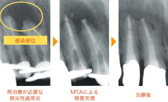 前歯の根の先の影(感染部位)が、根の中を薬で封じたあと、治療後には小さくなっているレントゲンの3枚