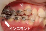 奥歯の歯ぐきに打った小さなネジ(アンカースクリュー)と、そこからワイヤーにかけた装置。画像の中に「インプラント」の文字と矢印