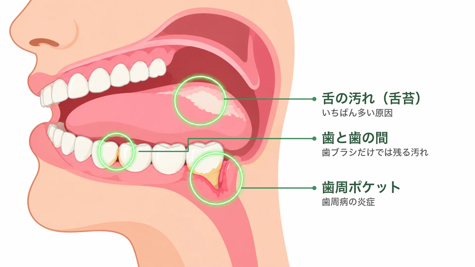 口の中の断面のイラスト。舌の汚れ（舌苔）、歯と歯の間、歯周ポケットの3か所が、口臭の主な原因の場所として示されている