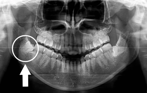 パノラマレントゲン写真。右下の親知らずを丸と矢印で示し、根の先が神経の管と重なって見える