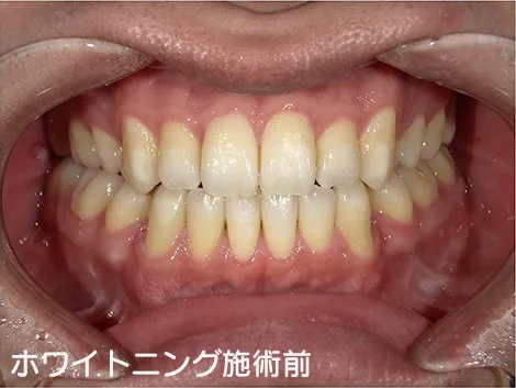 CASE 01 の施術前。上下の歯の列を正面から写した写真で、歯に黄ばみがある