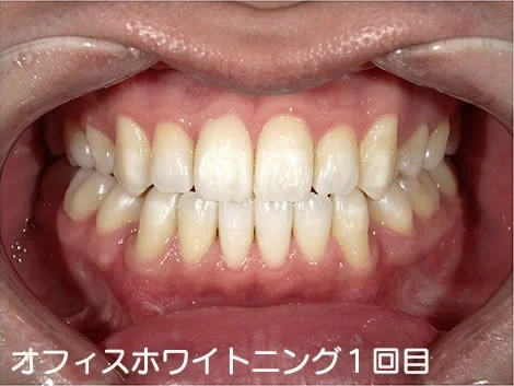 CASE 01 のオフィスホワイトニング1回目のあと。施術前より明るいが、黄ばみが少し残る