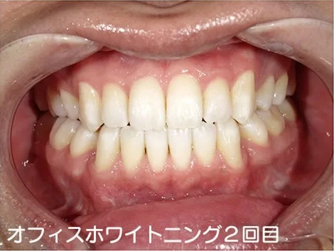 CASE 01 のオフィスホワイトニング2回目のあと。1回目よりさらに明るくなっている