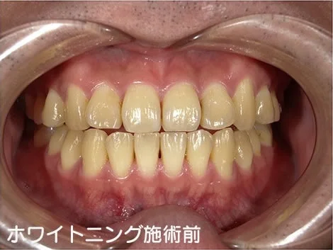CASE 02 の施術前。上下の歯の列が全体に黄色い
