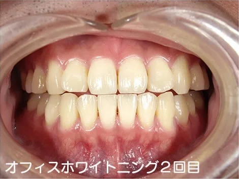 CASE 02 のオフィスホワイトニング2回目のあと。施術前より明るくなっている
