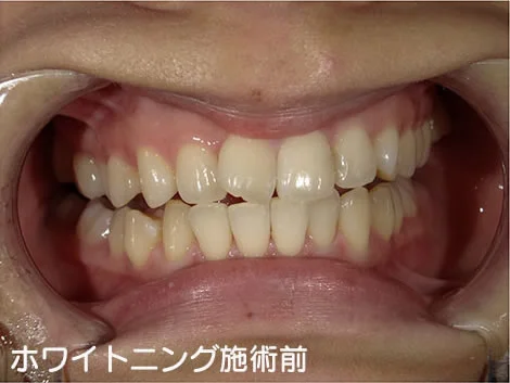 CASE 03 の施術前。上下の歯の列を正面から写した写真