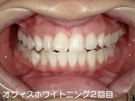 CASE 03 のオフィスホワイトニング2回目のあと。歯の列が白くなっている