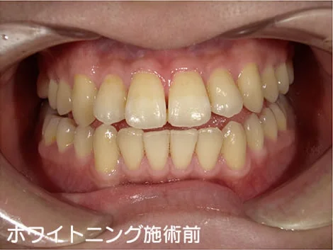 CASE 04 の施術前。上の前歯を中心に黄ばみがある