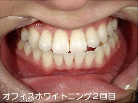 CASE 04 のオフィスホワイトニング2回目のあと。施術前より明るくなっている